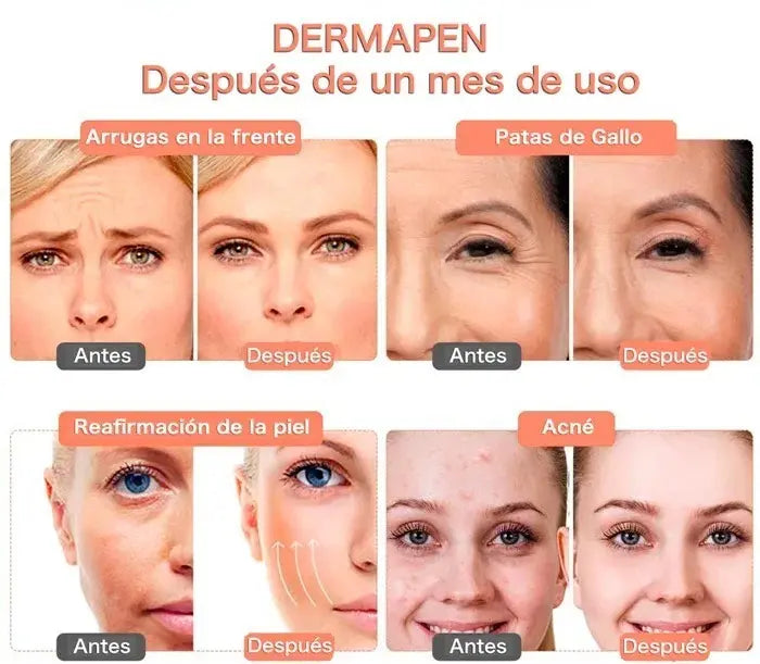 Máquina Dermapen Profesional — Rejuvenece tu Piel desde Casa ✨