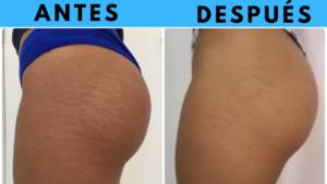 Sérum Lift Up | Glúteos Firmes y Definidos sin Cirugía